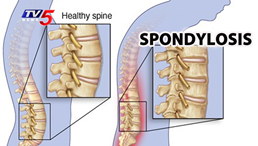 Spondylosis, Spondylolysis, and Spondylolisthesis: What's the difference?