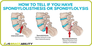Spondylolysis and Spondylolisthesis