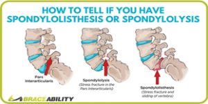 spondylosis vs spondylolisthesis symptoms